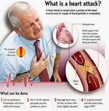 heart-attack-drsanati-حمله قلبی سایت دکتر حمیدرضا صنعتی