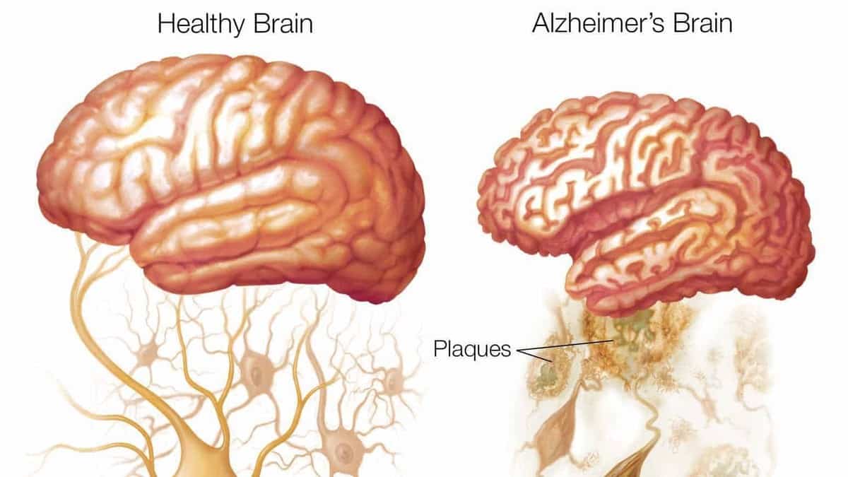 -alzheimers-brain-چگونه آلزایمر نگیریم؟ روشهای پیشگیری از آلزایمر در سایت دکتر حمیدرضا صنعتی فوق تخصص قلب و عروق