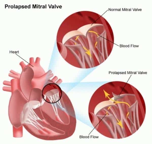 Mitral-Valve-Prolapse-ناهنجاری دریچه میترال در مطب دکتر حمیدرضا صنعتی بهترین فوق تخصص قلب و عروق خوب در تهران