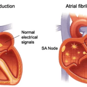 atrial-fibrillation - فیبریلاسیون دهلیزی- دکتر حمیدرضا صنعتی فوق تخصص قلب و عروق