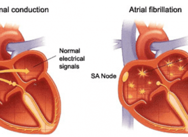atrial-fibrillation - فیبریلاسیون دهلیزی- دکتر حمیدرضا صنعتی فوق تخصص قلب و عروق